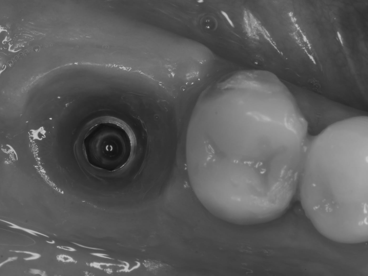 A healed single-implant site beside the adjacent teeth