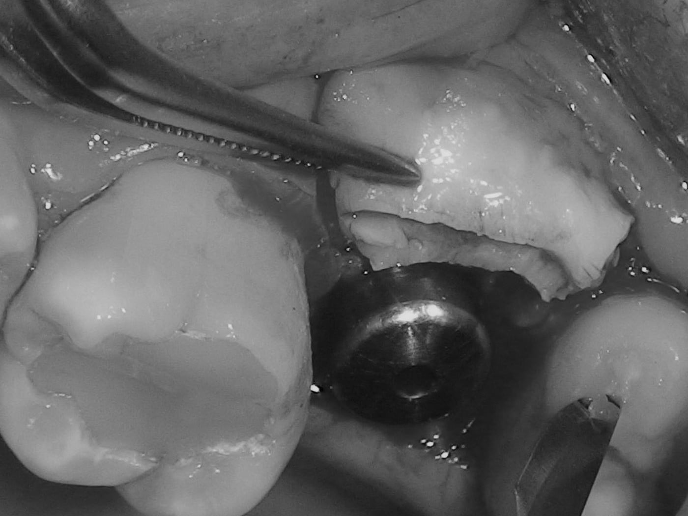 Intra-operative view of a posterior implant site